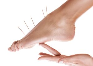 Acupuncture for neuropathy